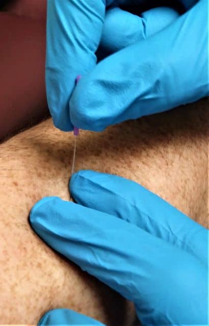 dry needling with acupuncture needle piercing skin