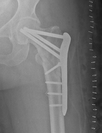 x-ray of Patti's fixated femur
